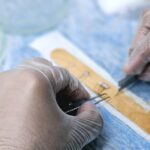 universal kidney transplant