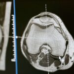 CT scan analysis