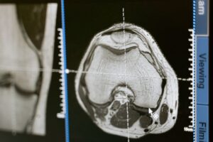CT scan analysis